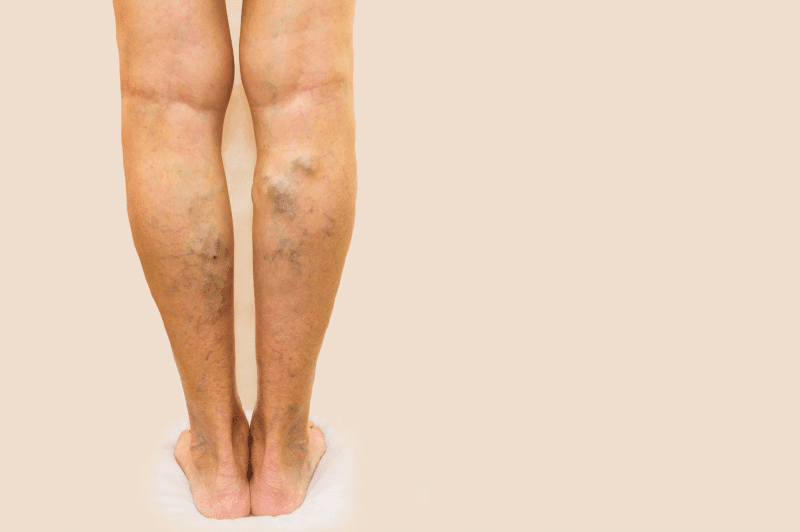 Varicose Veins Surgery Dubai